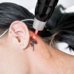 Notre laser Pico est idéal pour le traitement des imperfections cutanées, des tatouages indésirables, et des taches pigmentaires. Grâce à cette technologie révolutionnaire, nous pouvons traiter une variété de problèmes de peau avec un minimum de douleur et de temps de récupération. Venez découvrir comment le laser Pico peut transformer votre apparence.