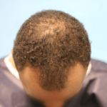 Nos traitements capillaires sont conçus pour répondre aux besoins de chaque client. Que vous souffriez de perte de cheveux, de cuir chevelu sec, ou que vous souhaitiez simplement revitaliser vos cheveux, nos experts vous aideront à trouver la solution parfaite. Nous utilisons des produits de haute qualité et des techniques avancées pour vous garantir des résultats visibles et durables.